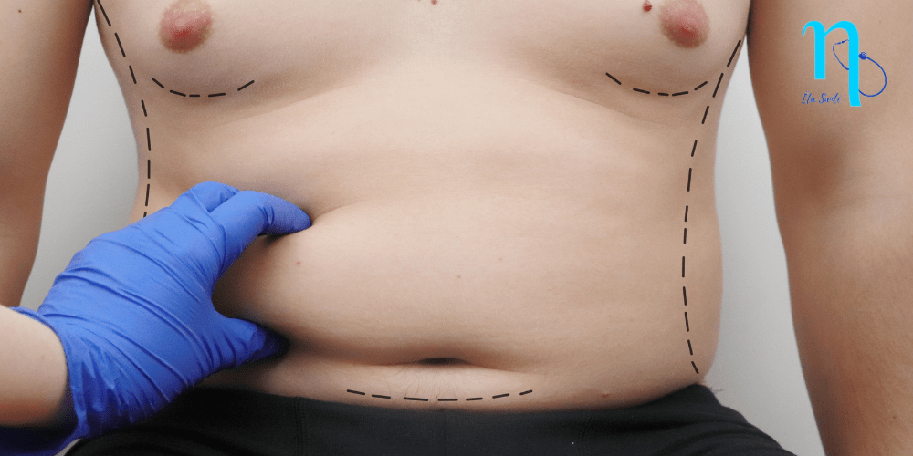 abdominoplastie en Tunisie