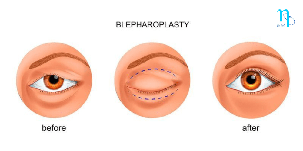 blépharoplastie tunisie prix