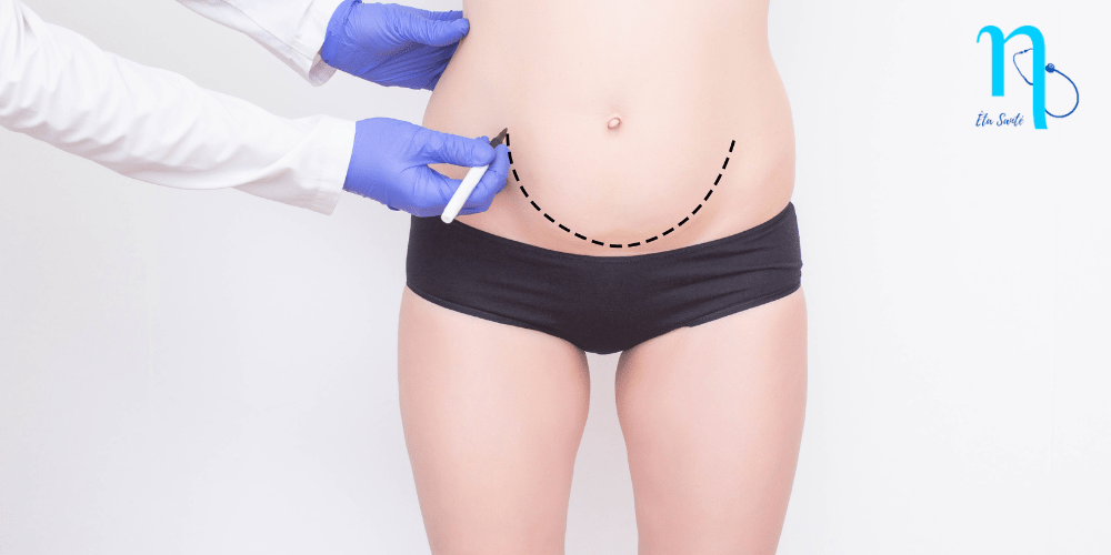 prix abdominoplastie tunisie pas cher