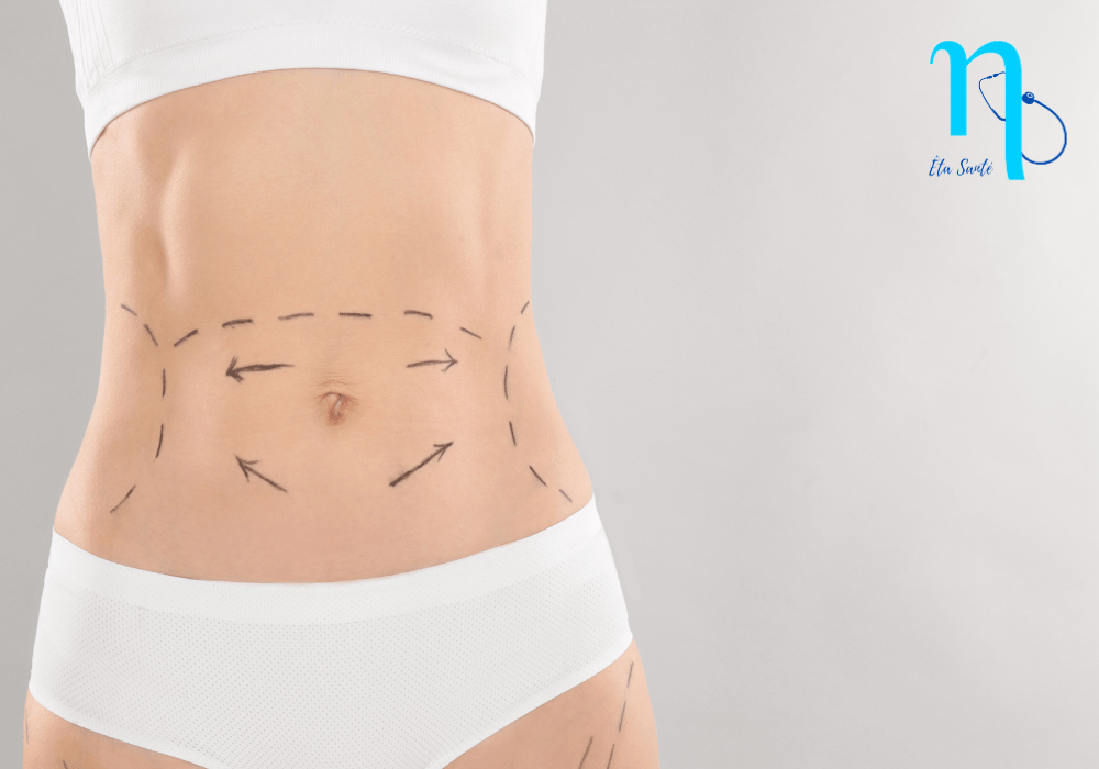 prix abdominoplastie tunisie