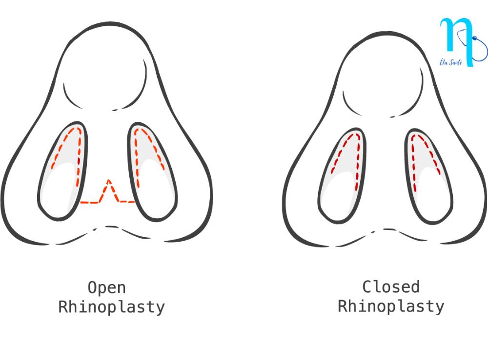 rhinoplastie ouverte fermee